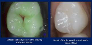How do you treat a cavity at home? Technology Matters In Dentistry Fluorescence Cavity Detection Poudre Valley Family Dental