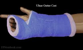 Image result for Radial Gutter Cast