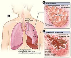 Lobar Pneumonia Wikipedia