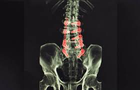 Failed Lumbar Fusion Atlanta Spinal Fusion Ga Spine Center