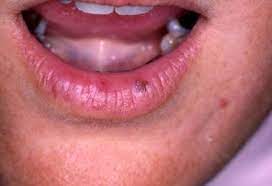 Homeopathic Treatment Of Oral Lichen Planus Homeopathy At Drhomeo Com