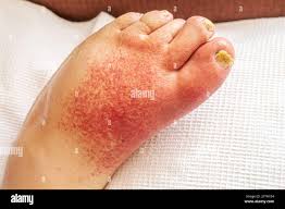 Image result for erysipel photos)