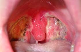 Image result for Tonsillectomy