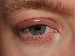 Zu beginn zeigt sich eine schwellung und rötung des augenlids, das bei berührung schmerzt. Blepharitis Wikipedia
