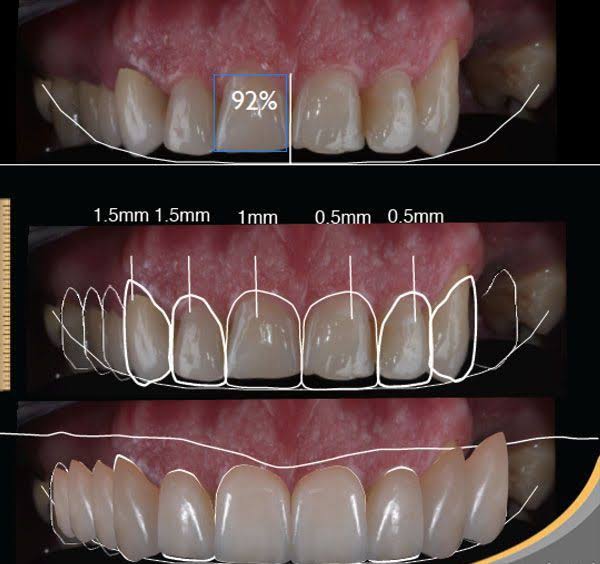 Smile design product image