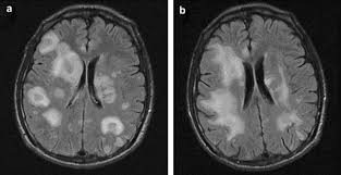 In cmv encephalitis, there is usually only non specific increased t2/flair signal in the white matter. The Clinical Presentation Diagnosis Treatment And Outcome Of Encephalitis Five Years Of Experience At A Medical Center In Northern Taiwan Sciencedirect