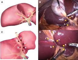 Systemic opioids should be considered as rescue analgesics. The Laparoscopic Glissonian Approach Is Safe And Efficient When Compared With Standard Laparoscopic Liver Resection Results Of An Observational Study Over 7 Years Sciencedirect