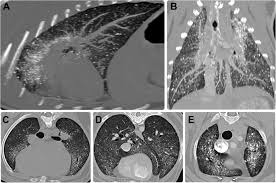 Maybe you would like to learn more about one of these? Clinicopathological And Imaging Features Of Pulmonary Alveolar Microlithiasis In A Dog A Case Report Bmc Veterinary Research Full Text
