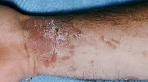 Image result for Photodermatitis