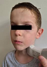 Point of Care Ultrasound (POCUS) Diagnosis of Deep Neck Space Abscess: A  Case Series