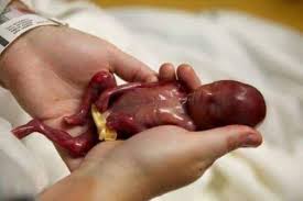 Resultado de imagen para el aborto en adolescentes