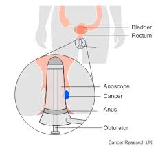 Image result for Anoscopy