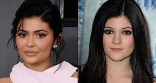 Kylie kristen jenner was born on august 10, 1997, in california and is an american model, socialite, fashion designer and reality tv star with few if any peers. Popbuzz On Twitter Kylie Jenner Finally Reveals What Surgery She S Actually Had Https T Co Zfdh12myol