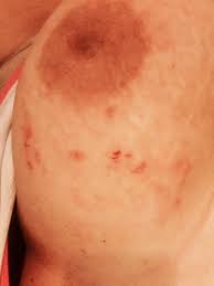 Inflammatory breast cancer cells grow along tiny channels (lymph vessels) in the skin of the breast. Breast Cancer Topic What Is Wrong With Me