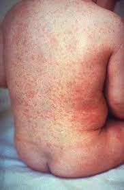 Ulcerative dermatitis is a skin disorder in rodents associated with bacterial. Exanthem Wikipedia