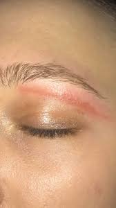 How long did it take to heal? Acne Using Differin Do Not Get Your Eyebrows Waxed Skincareaddiction