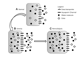 Dialysis Disequilibrium Syndrome Prevention And Management Ijnrd