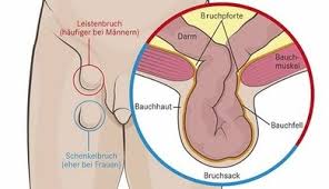 Leistenschmerzen Apotheken Umschau