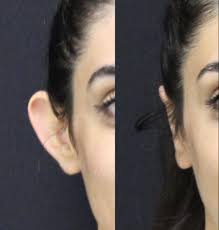 Kepce Kulak Estetigi Drilgidincok Kepcekulakameliyati Kepcekulak Otoplasti Otoplasty Kulakestetigi Kocaelikulakestetigi Kocaelikepcekulakamel Kulak