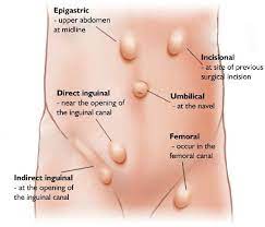 Having a professional examine your hernia and provide confirmed. Ohima Blog Coding Hernias