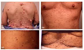 Dermatologic Manifestations of Neurofibromatosis Type 1 and Emerging  Treatments
