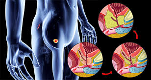 These early prostate cancer symptoms are mainly due to obstruction of the flow of urine out of the bladder. The First Symptom Of Prostate Cancer Everyone Should Watch Out For Top Doctor Reveals How Africa News