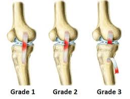 A hyperextended knee is often easy to spot when it happens. Knee Sprain Symptoms Diagnosis Treatment Knee Pain Explained