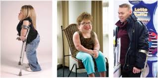 Unique Medical Issues In Adult Patients With Mucopolysaccharidoses Sciencedirect