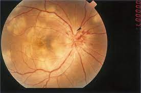 Gass initially suggested that inflammation of the retinal pigment epithelium. Acute Posterior Multifocal Placoid Pigment Epitheliopathy With Retinal Vasculitis And Papillitis Eye