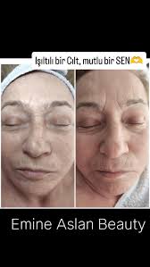 Cildinizin derinlemesine nefes almasını sağlayan gerçek bir dokunuşa hazır  olun ✨, _____________________________________________________, Detaylı  bilgi ve randevu için 📞 0543 191 08 09, Emine Aslan ...