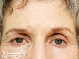 Furthermore, it aims to elevate the height of the eyebrows as well. Botox Before After Photos Botox Brow Lift Eyebrow