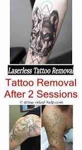 Tattoo Entfernung Saure Kit Tattoo Narbe Entfernung Creme Wahre Verblassen Tattoo Entfernung Revie Laser Tattoo Eyebrow Tattoo Removal Tattoo Removal Cost