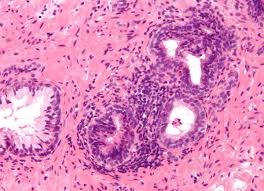 Prostate cancer is a common type of cancer in men, according to the mayo clinic. Prostatitis Wikipedia