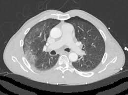 Image result for Pulmonary Contusion