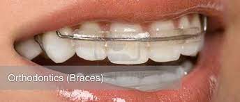 Getting braces done at private dentists. Malaysia Smile Orthodontics Braces