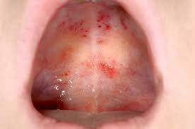 These purpura spots are caused by small hemorrhages under the skin and are not associated with abnormally low levels of platelets (nonthrombocytopenic) as is common with some other forms of purpura. Lymphoma Action Thrombocytopenia Low Platelets