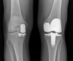 The healing process takes time and the one of the biggest determinants of successful patient outcome after knee replacement surgery is the. Dr Craig J Della Valle Hip And Knee Surgeon Partial Knee Replacement Dr Craig J Della Valle Hip And Knee Surgeon