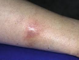 Tuberculosis cutis indurativa definition at dictionary.com, a free online dictionary with pronunciation, synonyms and translation. Tuberculids Dermnet Nz