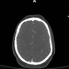Image result for CT Head