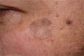 Image result for Solar Lentigo