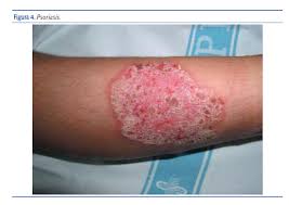 Image result for dermatitis contacta toxica
