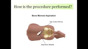 Image result for Bone Marrow Exam