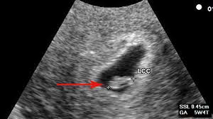 Die ctg hilft, den herzschlag des ungeborenen babys zu überwachen: 6 Ssw Kannst Du Schon Das Herz Auf Dem Ultraschall Sehen Hallo Eltern