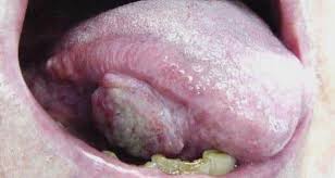 Image result for white cancer on tongue)