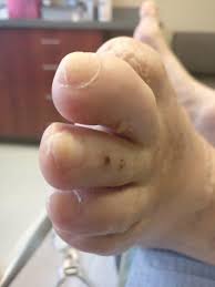 Maybe you would like to learn more about one of these? White Patches On Toenails Causes Signs Best Treatment