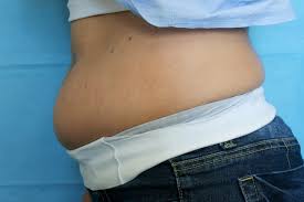 Image result for Lipodystrophy