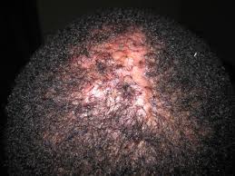 Scalp folliculitis or acne necrotica miliaris is an inflammatory disorder of the hair follicles in the scalp. Scalp Inflammation Treatment Atlanta Hair Loss Treatment Clinic Nina Ross Atlanta Trichology