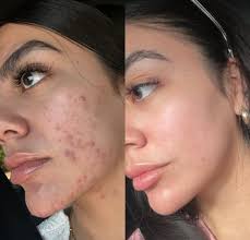 JENNY BRANHAM • ACNE SKINCARE SPECIALIST (@acnespecialistokc) • Instagram  photos and videos
