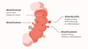 The most frequent issues with the bowel or colon, affect the colon's ability to work properly. What Does A Diverticulitis Attack Feel Like Symptoms Risk Factors