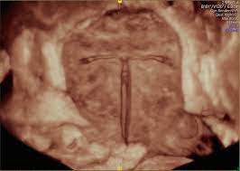 How is an iud removed? The Effectiveness Of Using Ultrasound For Iud Removal Empowered Women S Health